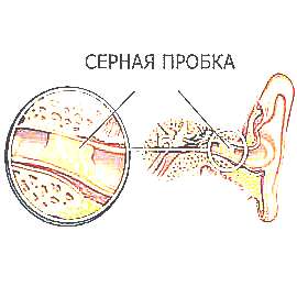 Серные пробки в ухе (рисунок)